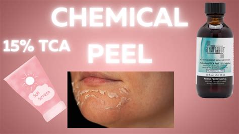 tca peel reviews|best tca peel brands.